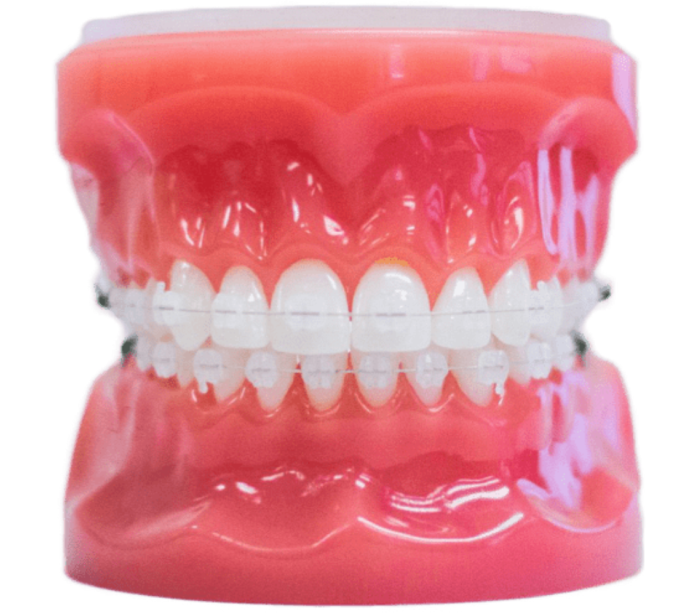 invisalign aligners on plastic model
