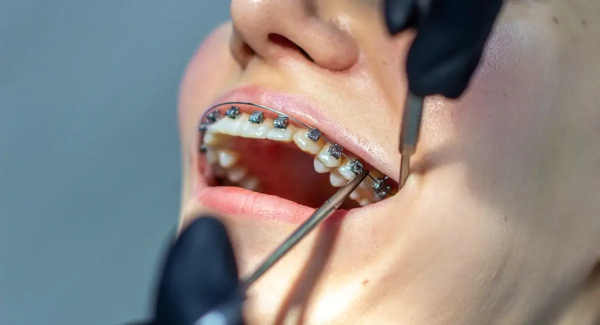 What to Do in Case of an Orthodontic Emergency