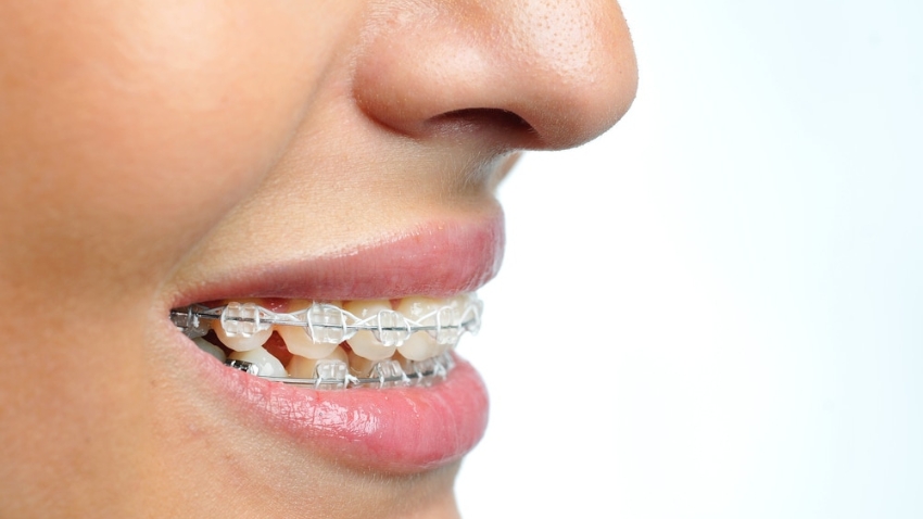 can clear braces fix your smile