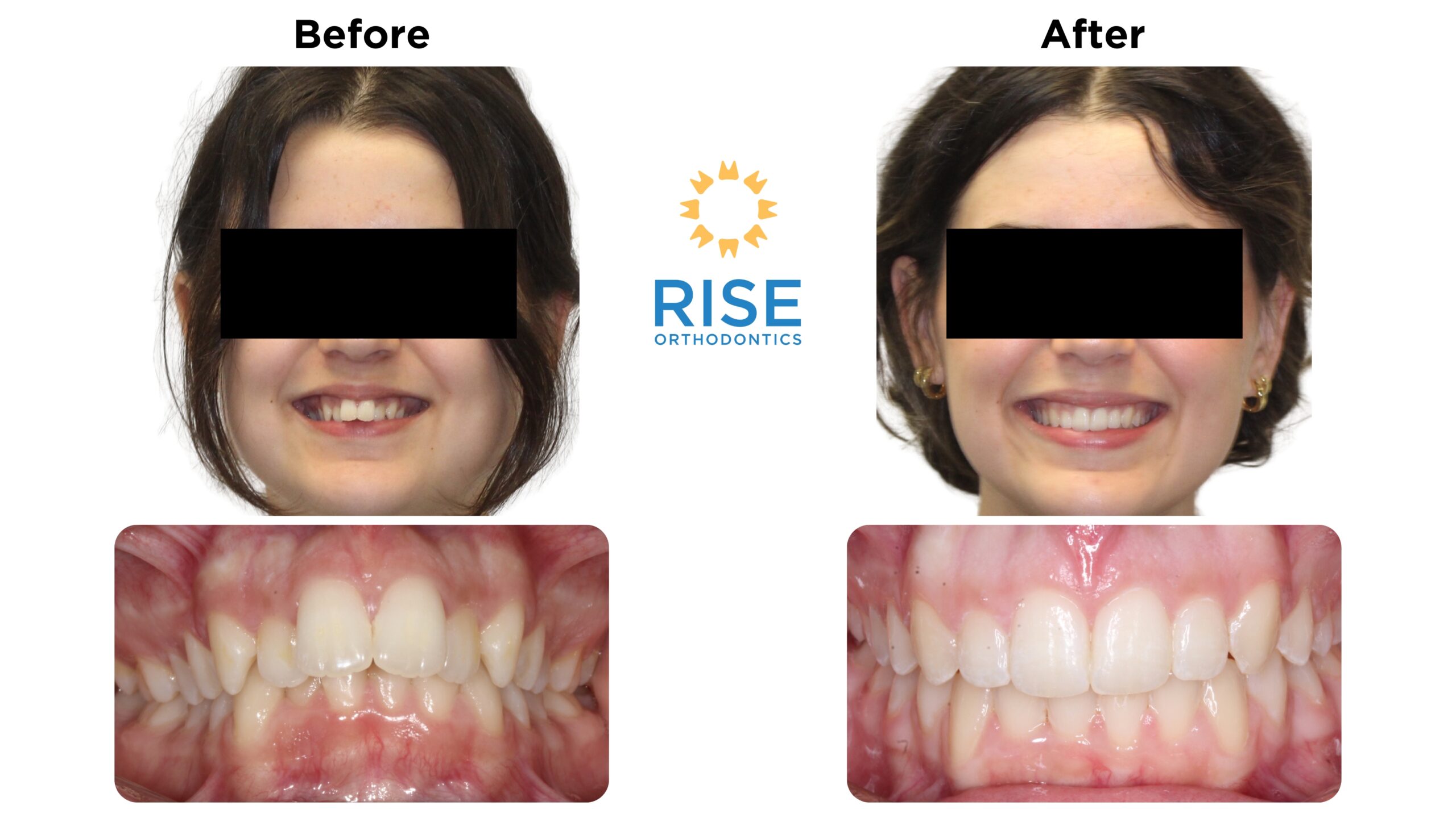 Before and after images of a patient’s orthodontic treatment, showcasing improved dental aesthetics with a bright smile and straightened teeth, featuring the Rise Orthodontics logo.