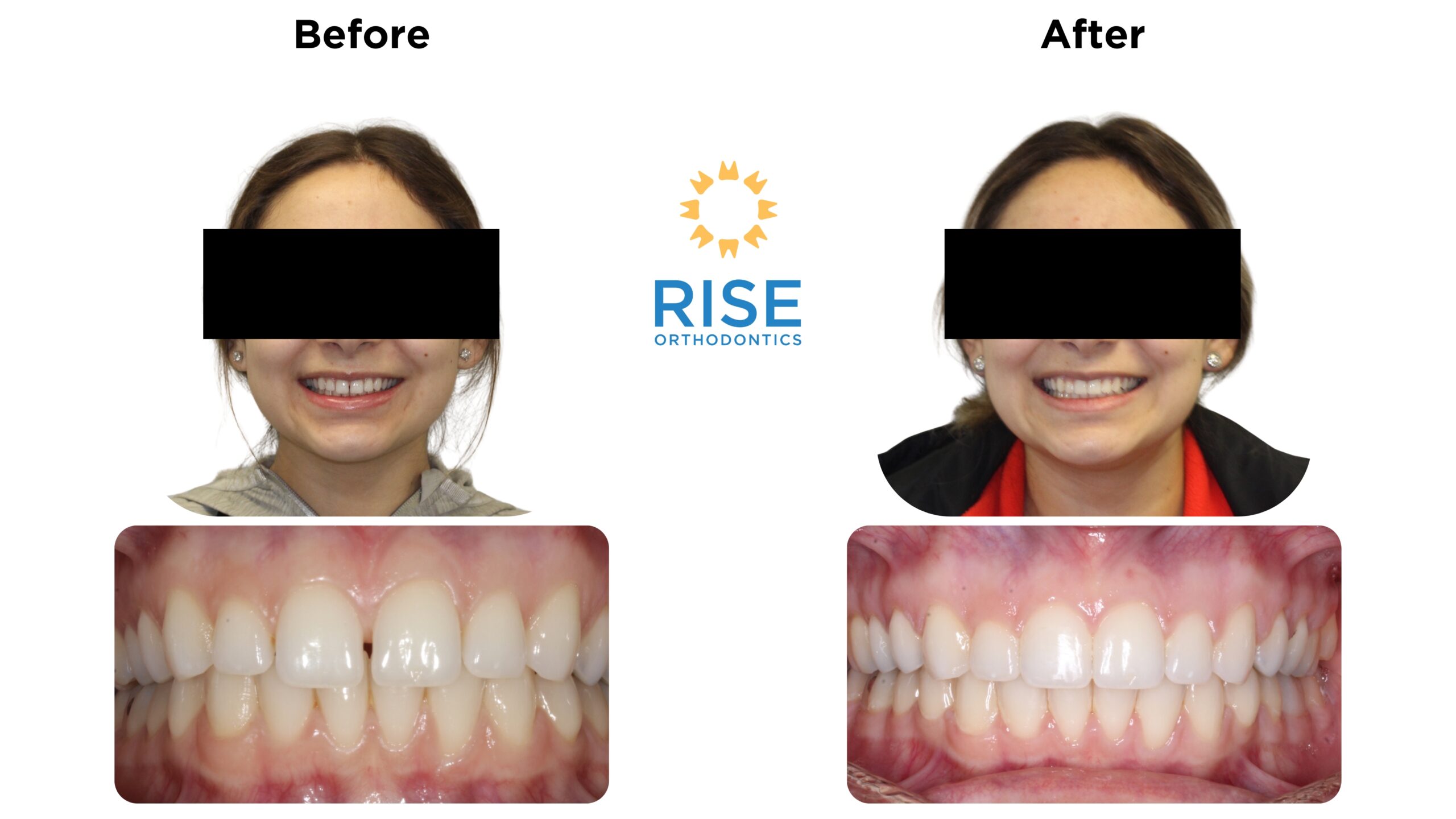 Before and after orthodontic transformation showcasing a patient's smile improvement with straightened teeth, featuring the Rise Orthodontics logo.