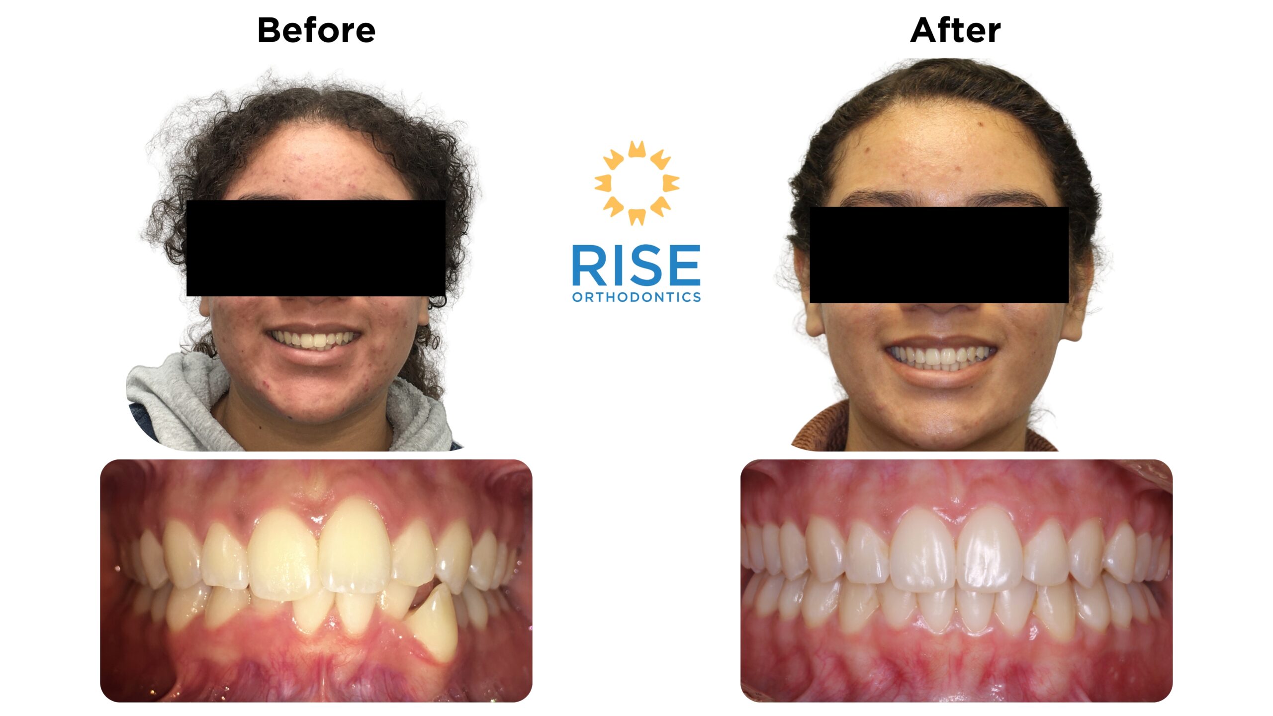 Before and after images of a patient treated at Rise Orthodontics, showcasing improved smile and teeth alignment with braces or Invisalign.
