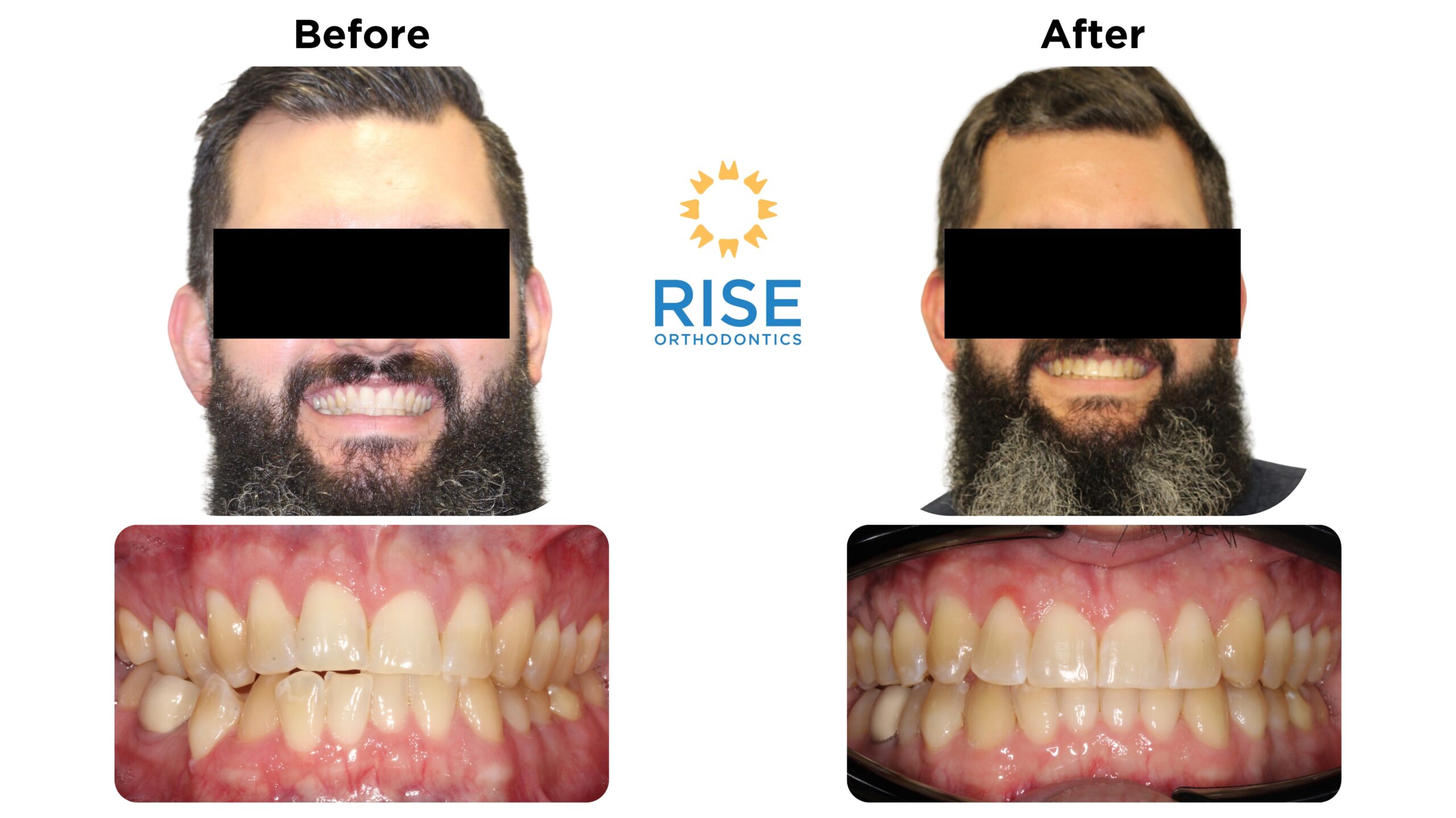 Before and after images of a male patient showcasing orthodontic transformation, featuring improved dental alignment and aesthetics, with the Rise Orthodontics logo prominently displayed.