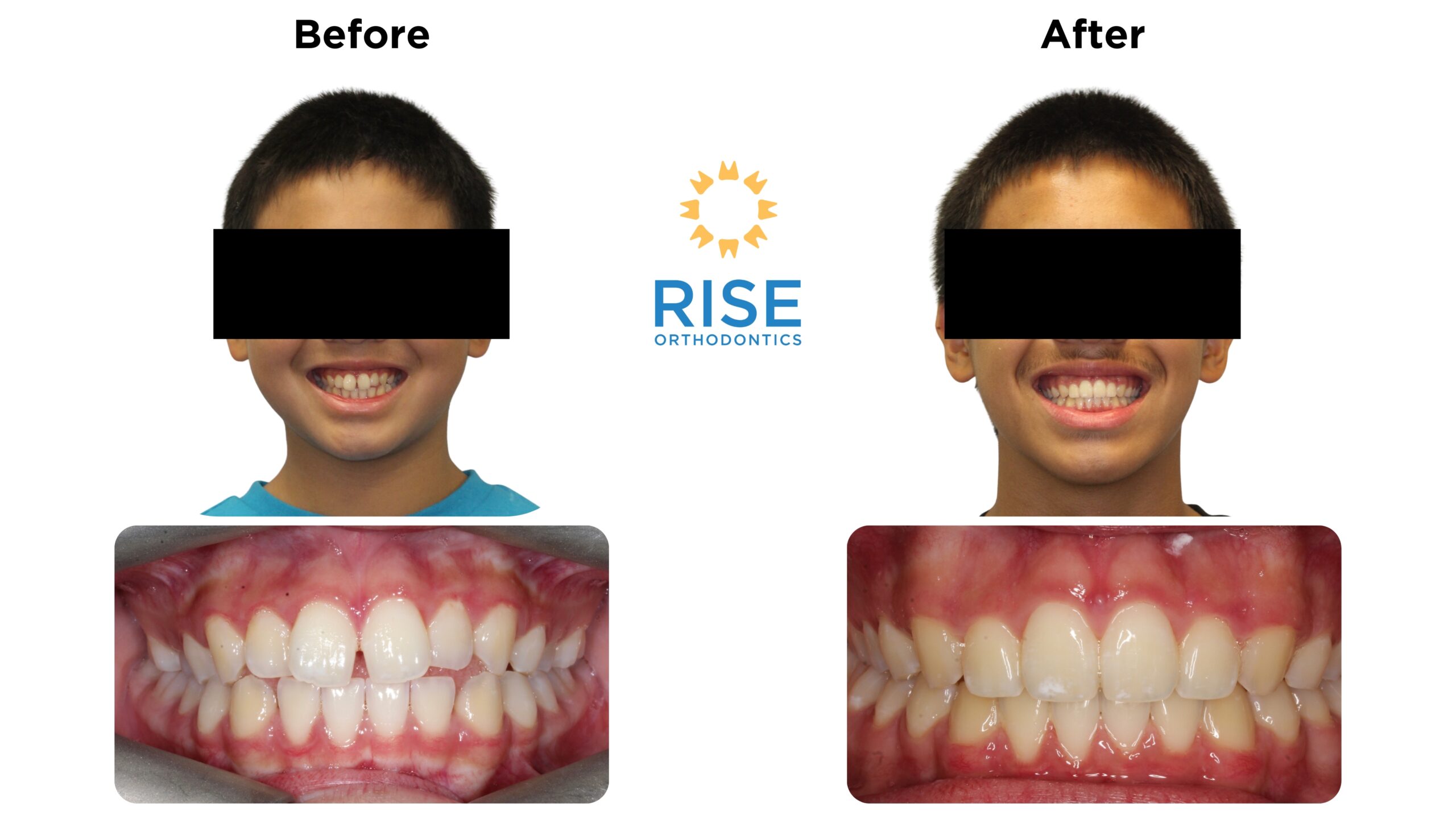 Before and after orthodontic treatment showcasing a patient's smile transformation with improved dental alignment, featuring the logo of Rise Orthodontics.