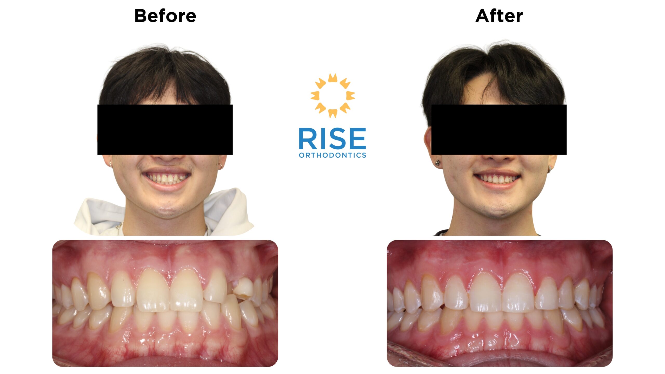 Before and after images of a patient treated at Rise Orthodontics, showcasing improved dental aesthetics with a confident smile and aligned teeth.
