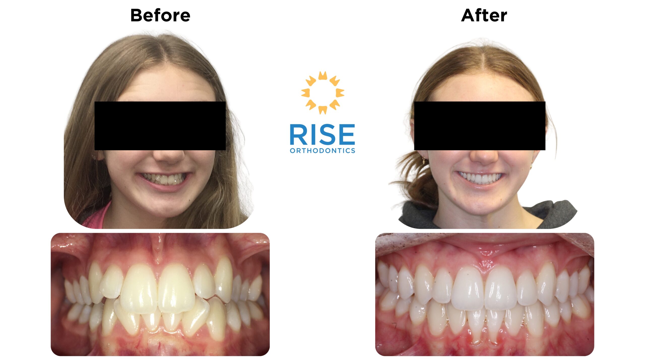 Before and after orthodontic treatment images showing a patient's smile transformation, featuring improved alignment and aesthetics of teeth, with the Rise Orthodontics logo in the center.