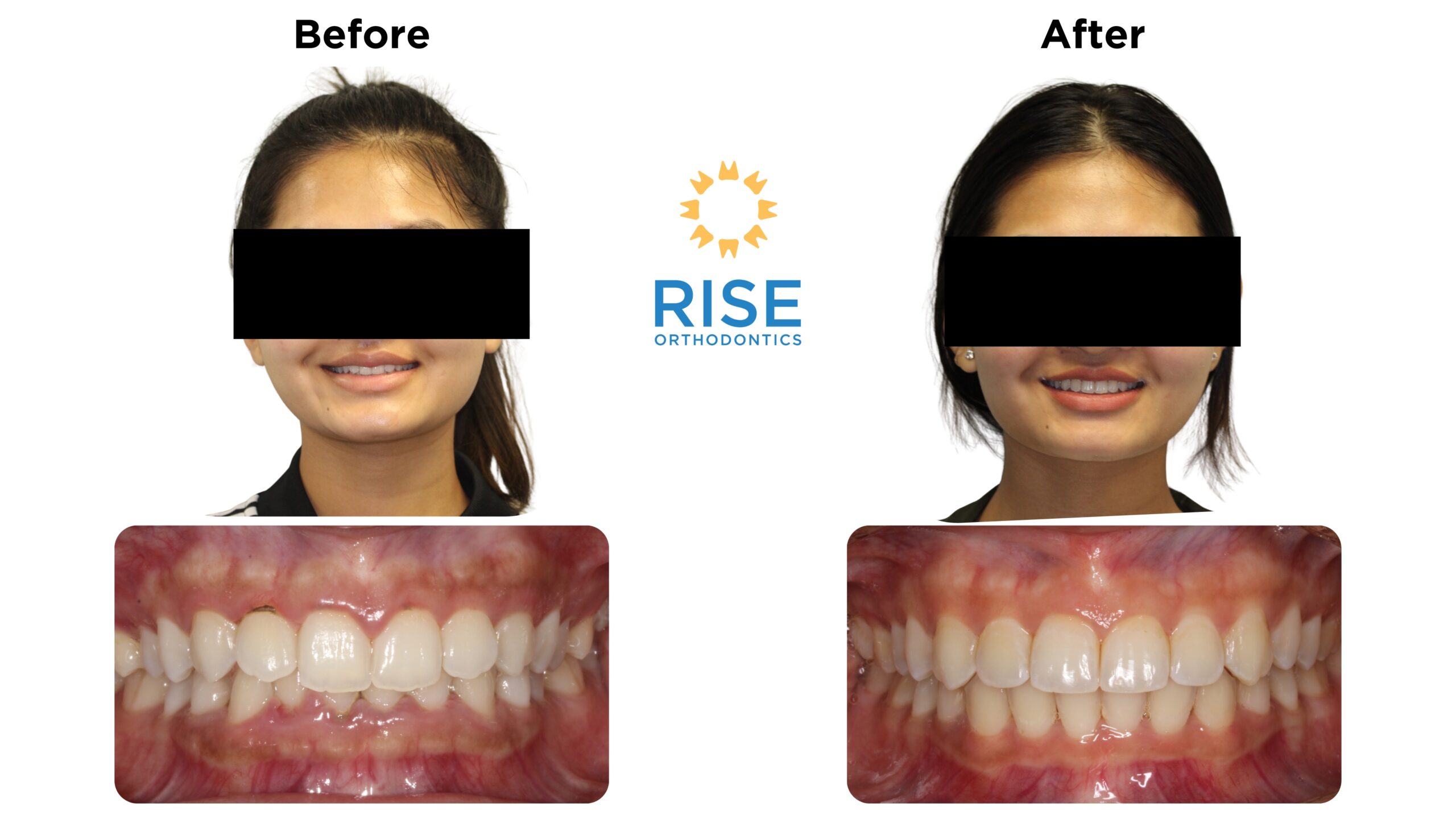 Before and after orthodontic treatment showcasing improved smile and dental alignment at Rise Orthodontics, featuring a patient’s transformation with braces or Invisalign.
