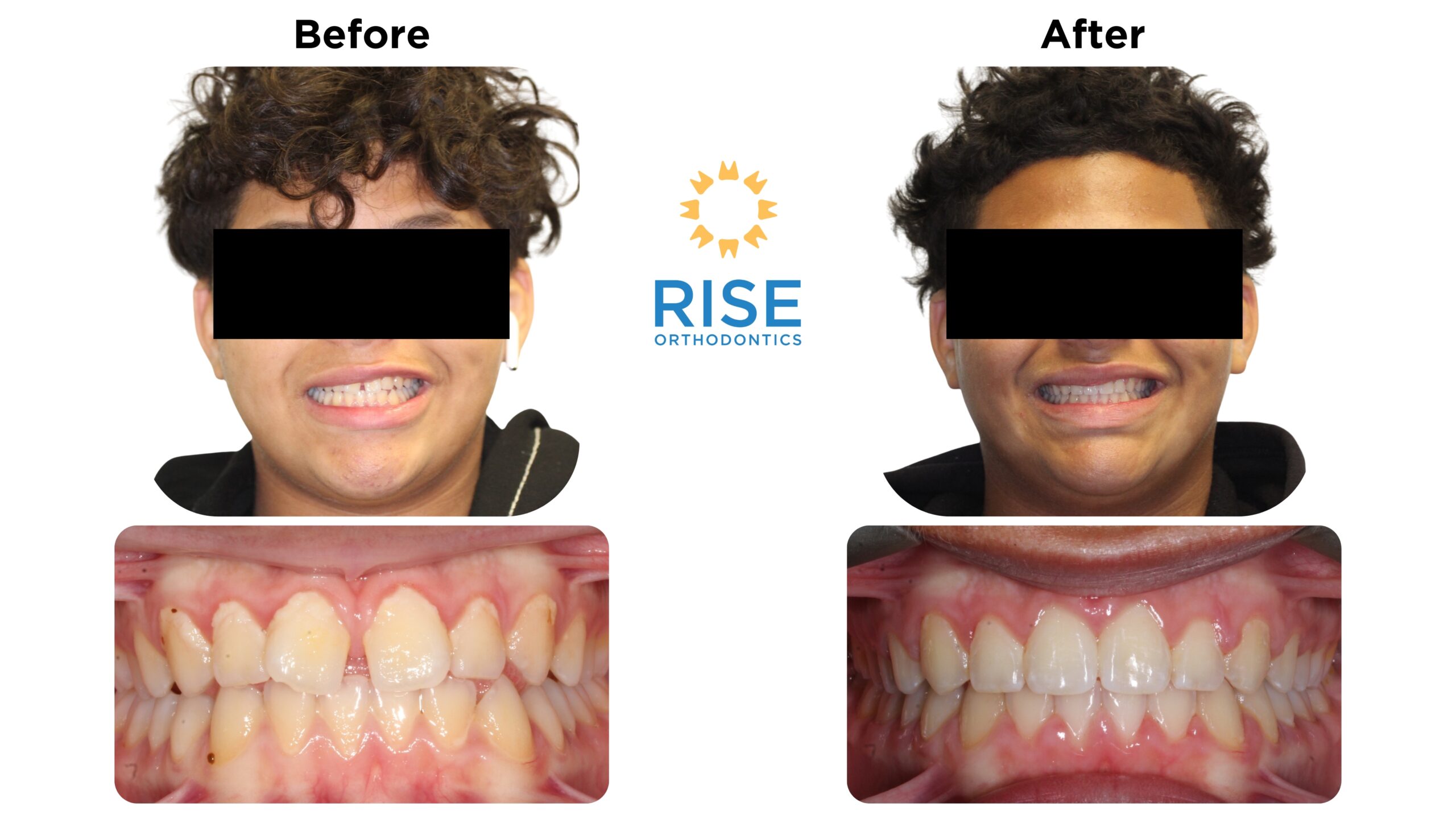 Before and after orthodontic treatment at Rise Orthodontics, showcasing improved smiles and dental alignment, featuring a patient with braces.