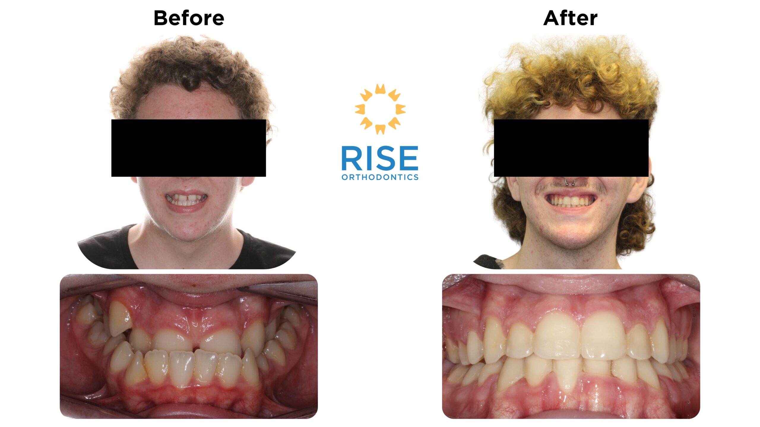 Before and after images of a patient showcasing orthodontic transformation by Rise Orthodontics, highlighting improved dental alignment and aesthetics.