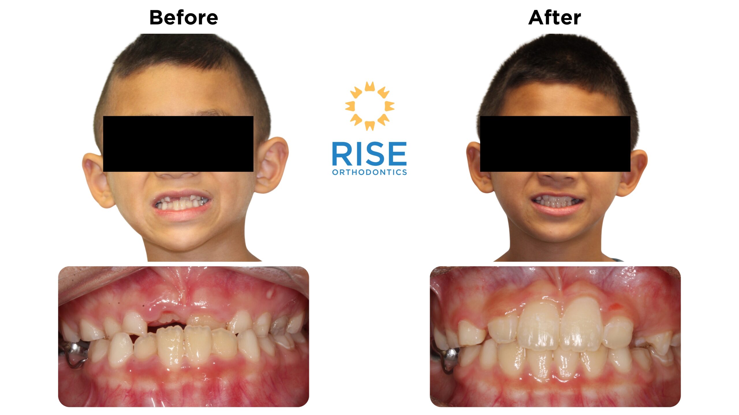 Before and after orthodontic transformation of a child, showcasing improved dental alignment and aesthetics, featuring the logo of Rise Orthodontics.