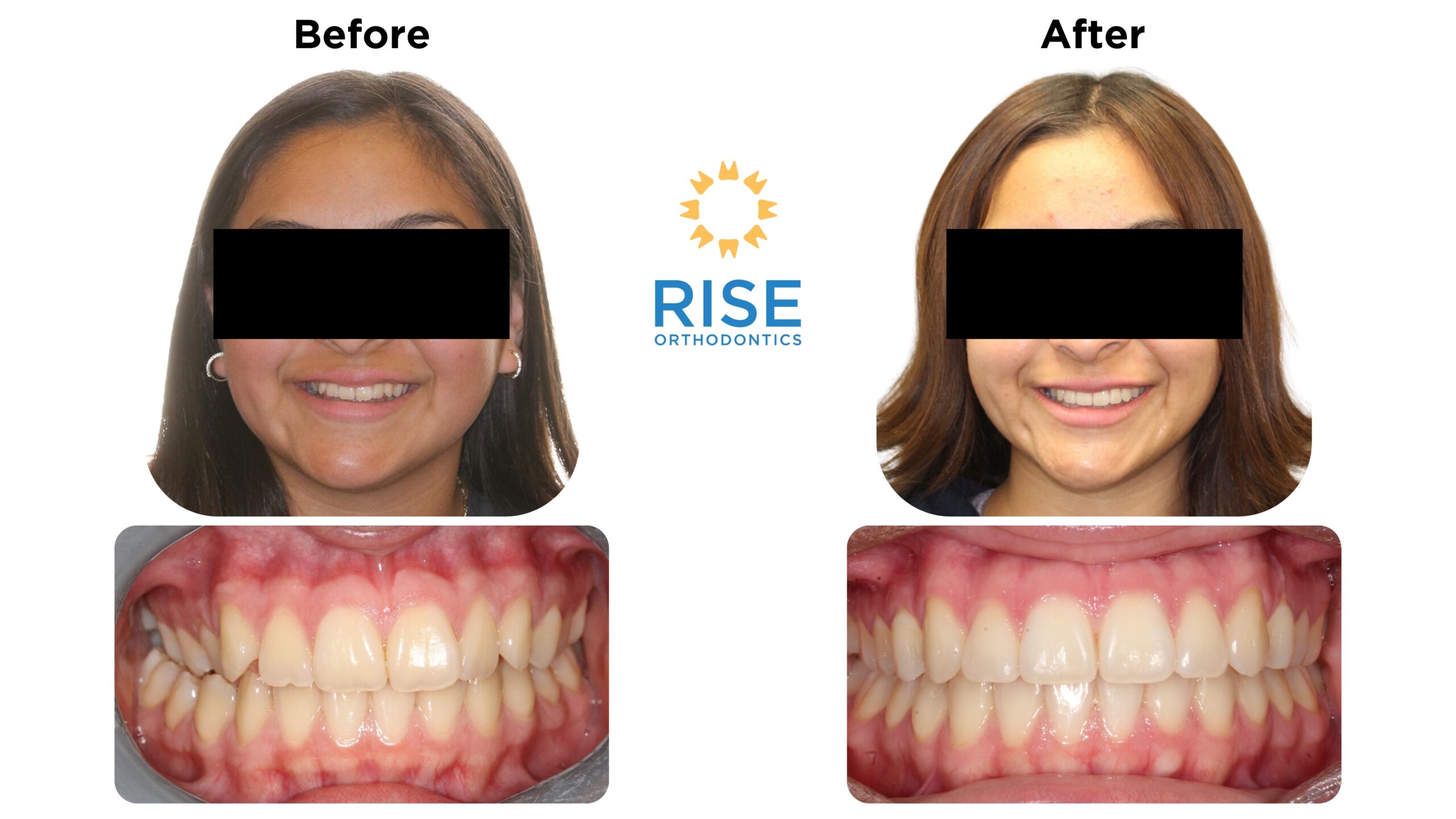 Before and after images of a patient showing orthodontic transformation, featuring improved smile aesthetics and alignment, with Rise Orthodontics logo in the center.