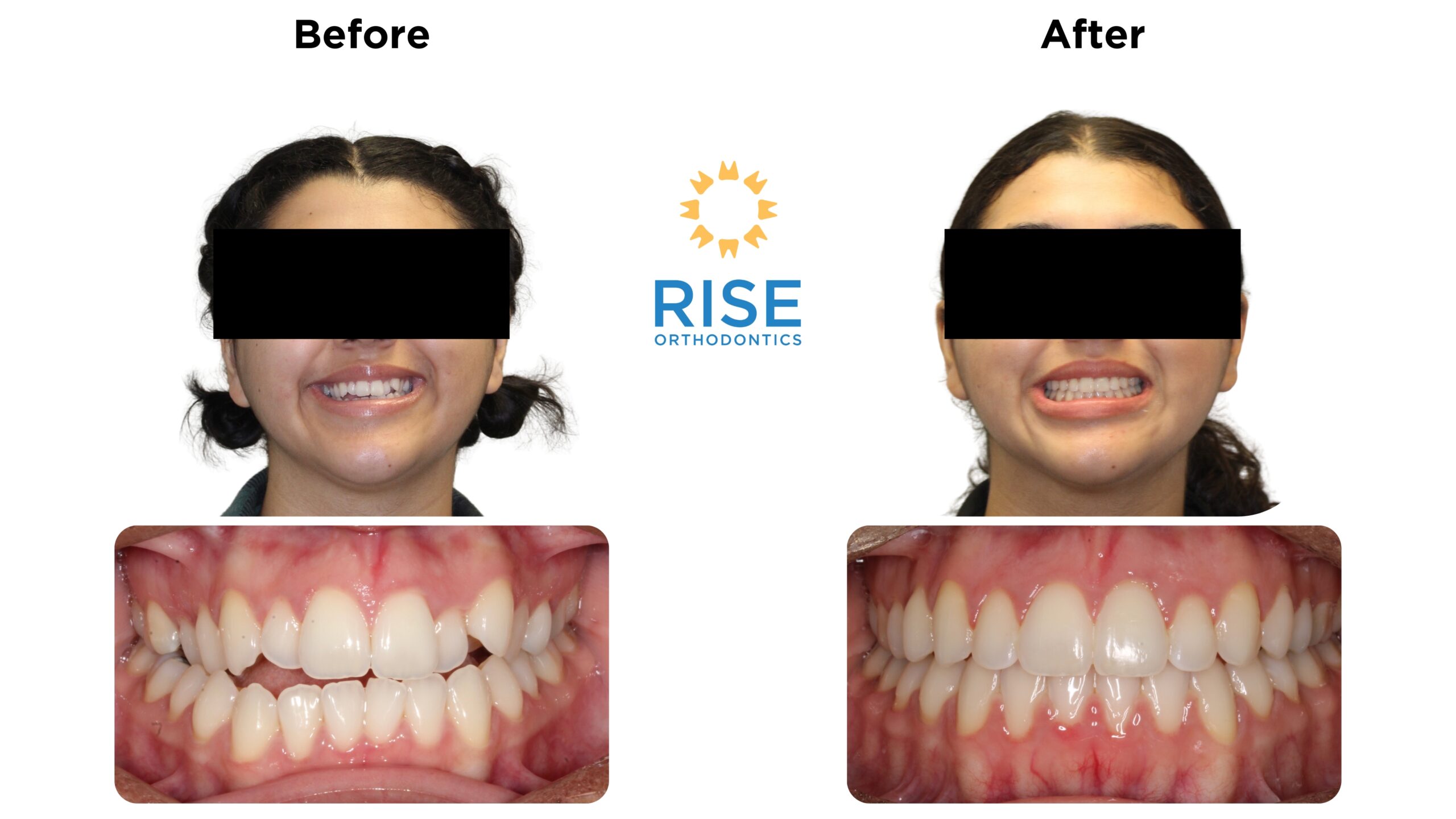 Before and after orthodontic treatment images showcasing a patient's smile transformation with braces, highlighting improved dental alignment and aesthetics, featuring the Rise Orthodontics logo.