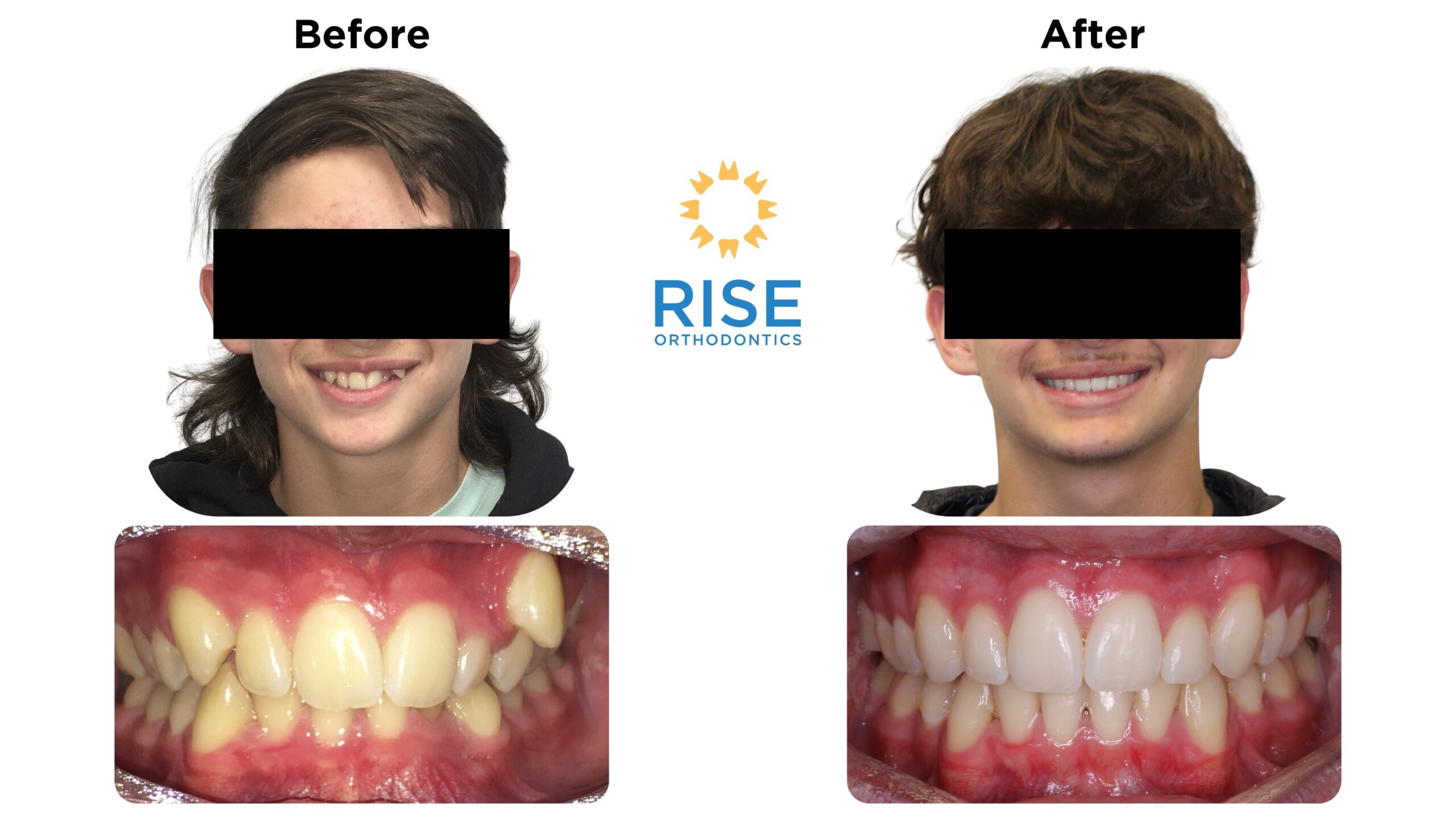 Before and after orthodontic transformation showing improved dental aesthetics, featuring a smiling patient with straightened teeth, logo of Rise Orthodontics in the center.