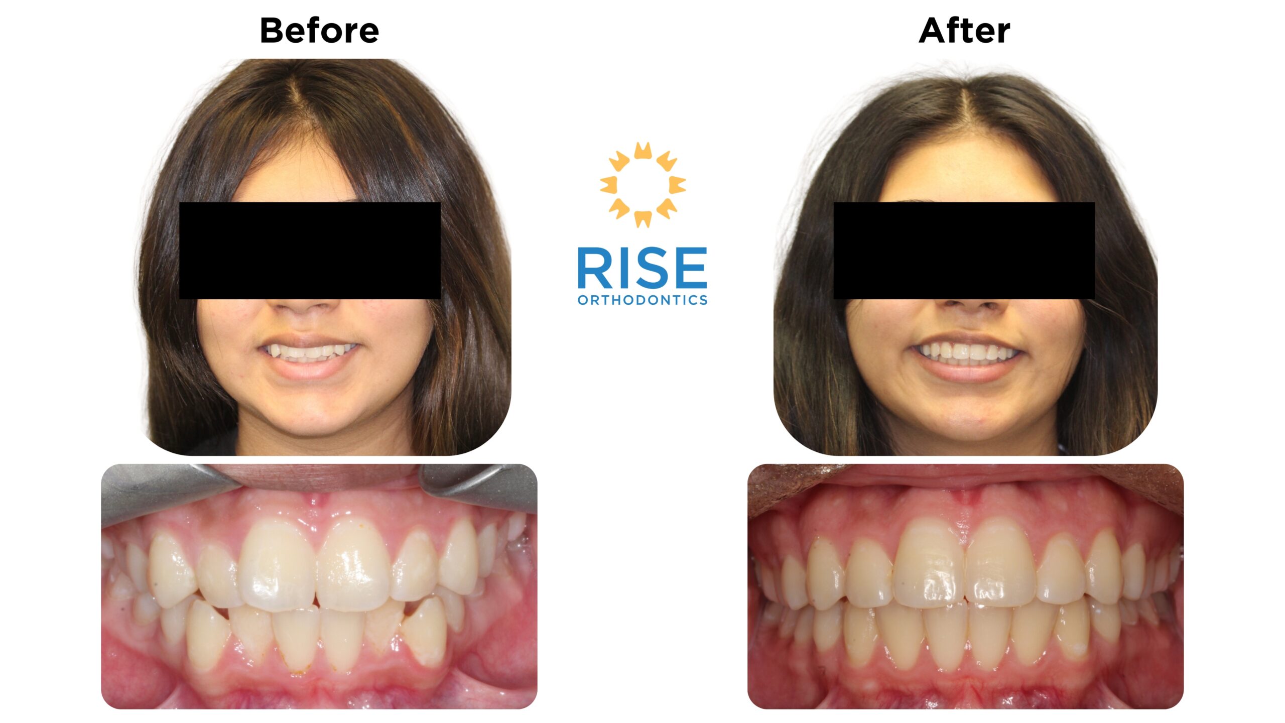Before and after images of a patient treated at Rise Orthodontics, showcasing improved dental aesthetics with straightened teeth and enhanced smile confidence.