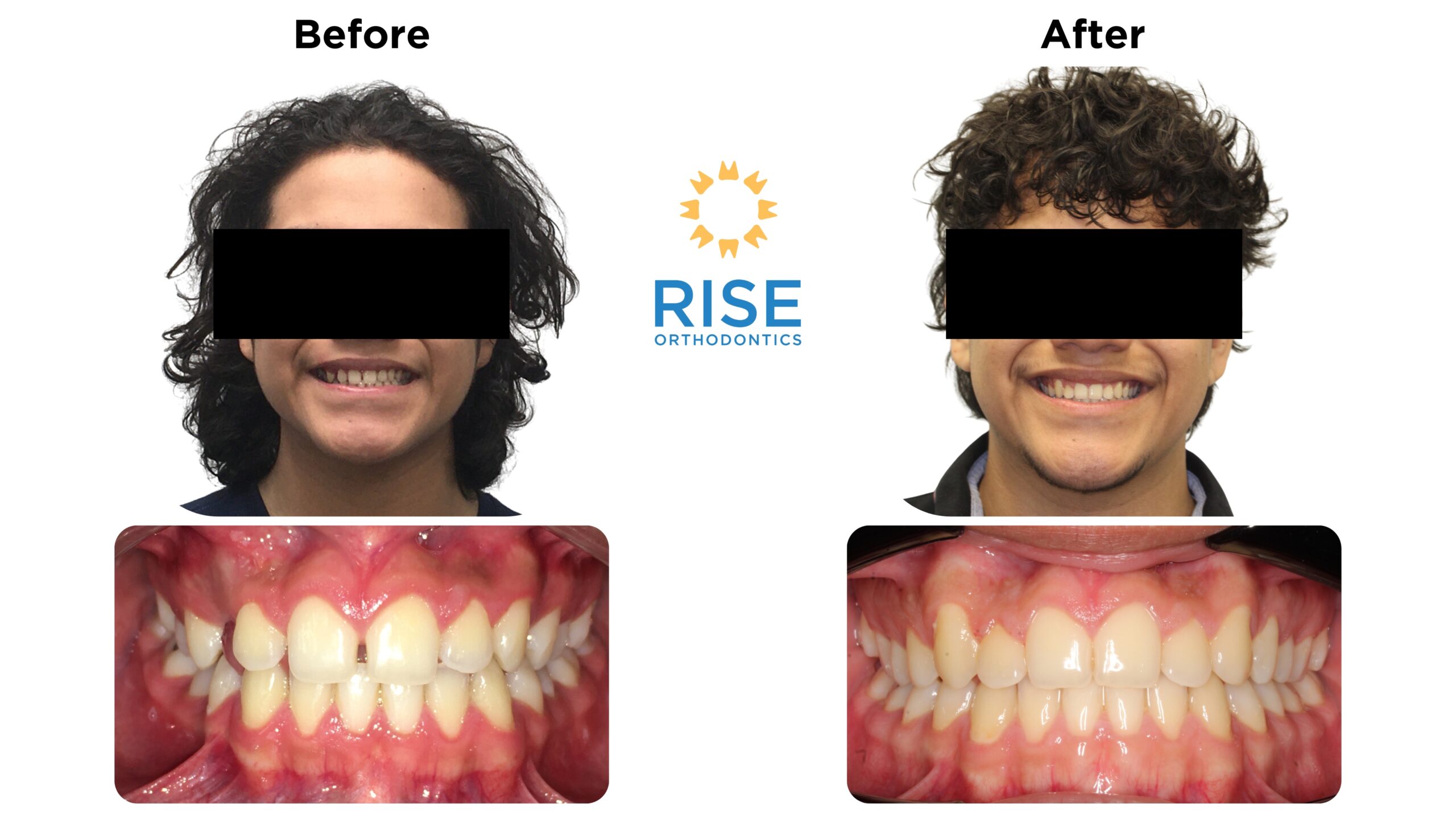 Before and after orthodontic treatment comparison showcasing improved dental aesthetics, featuring a patient smiling with braces, highlighting the transformation facilitated by Rise Orthodontics.