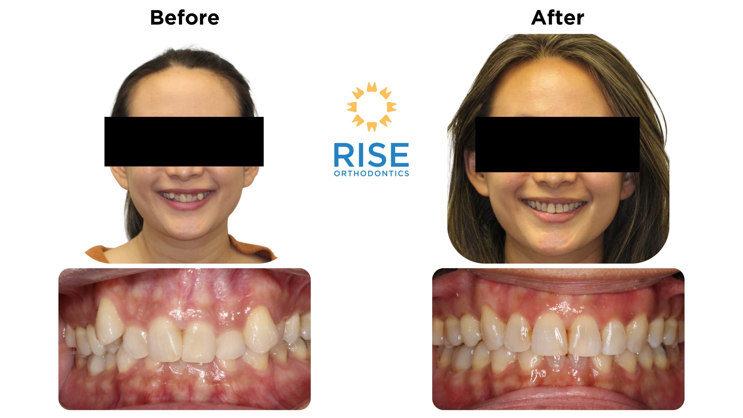 Before and after orthodontic transformation showcasing improved smile and dental alignment, featuring patient images from Rise Orthodontics.