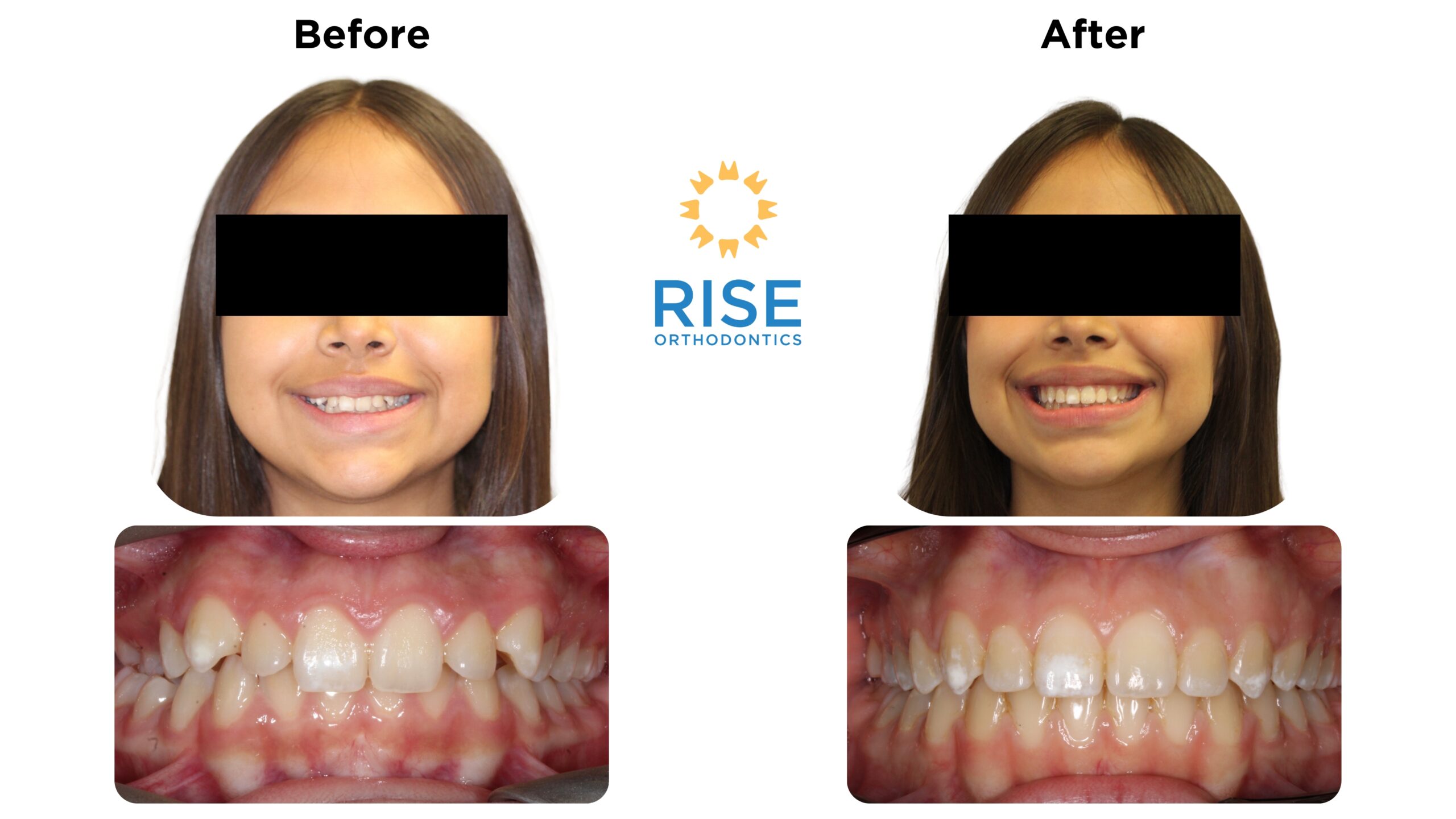 Before and after images of a patient showing orthodontic transformation with improved smile aesthetics, featuring the logo of Rise Orthodontics.