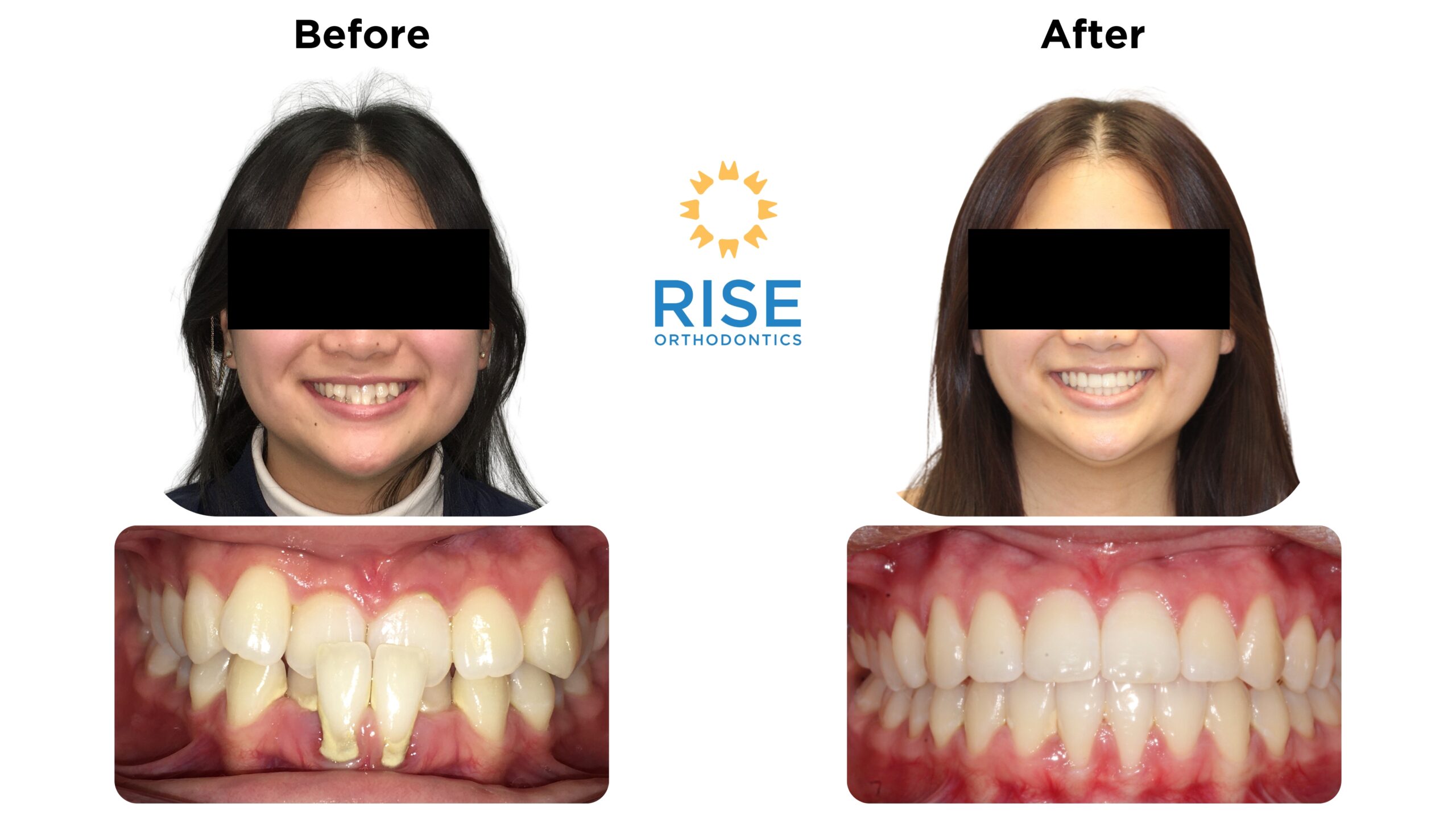 Before and after orthodontic treatment at Rise Orthodontics, showcasing improved dental alignment and aesthetics with patient smiles and teeth transformations.