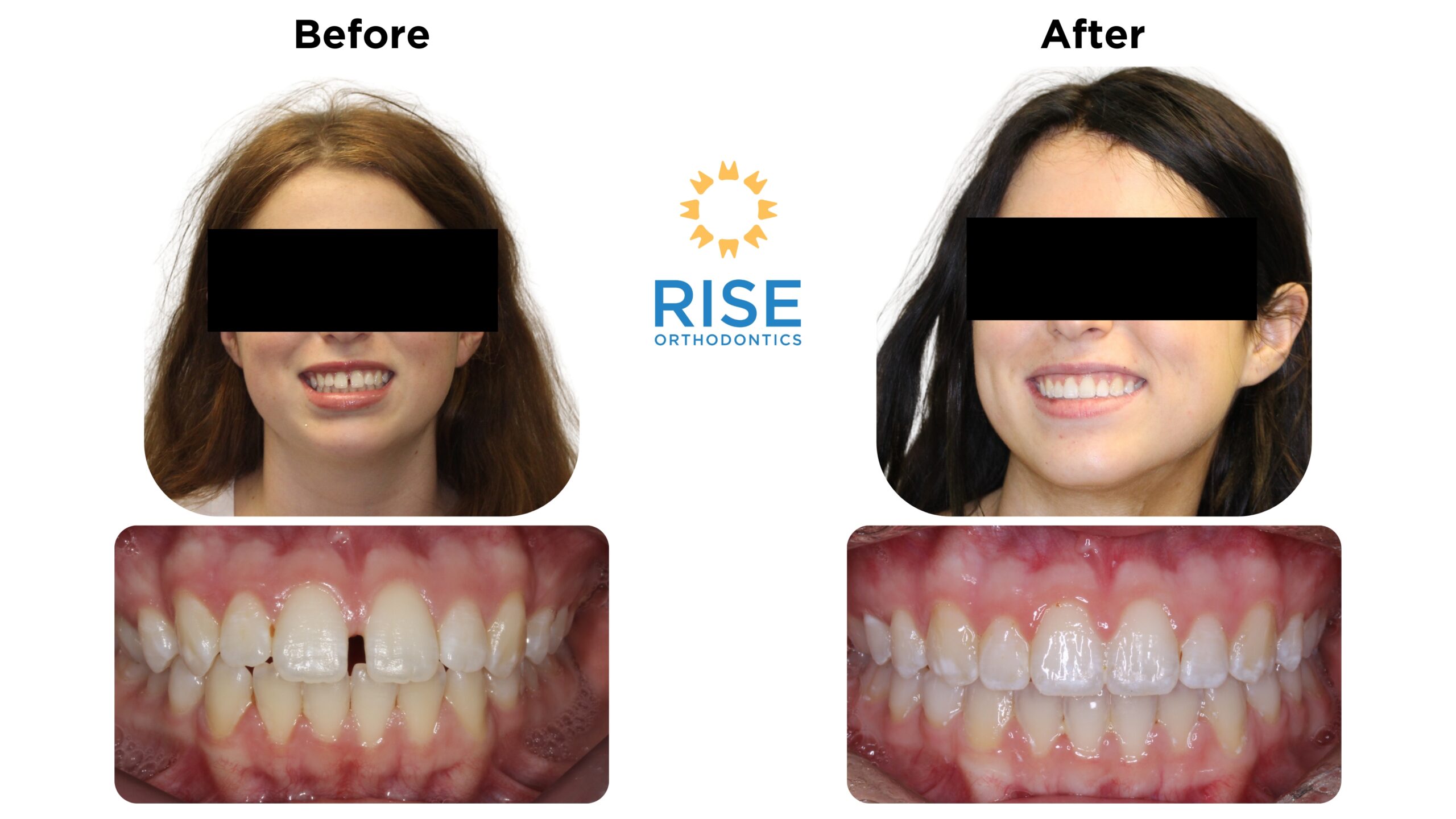 Before and after images of a patient treated at Rise Orthodontics, showcasing improved dental aesthetics with braces or Invisalign, featuring a smiling individual with straightened teeth.