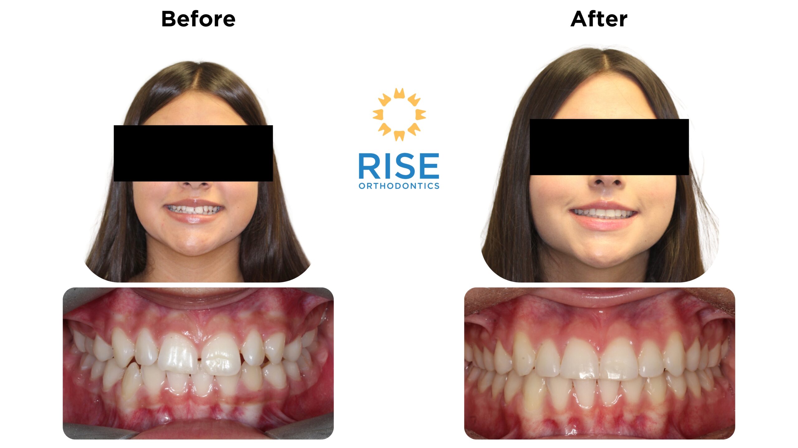 Before and after orthodontic transformation of a patient at Rise Orthodontics, showcasing improved dental aesthetics with braces, featuring frontal and side views of the smile.