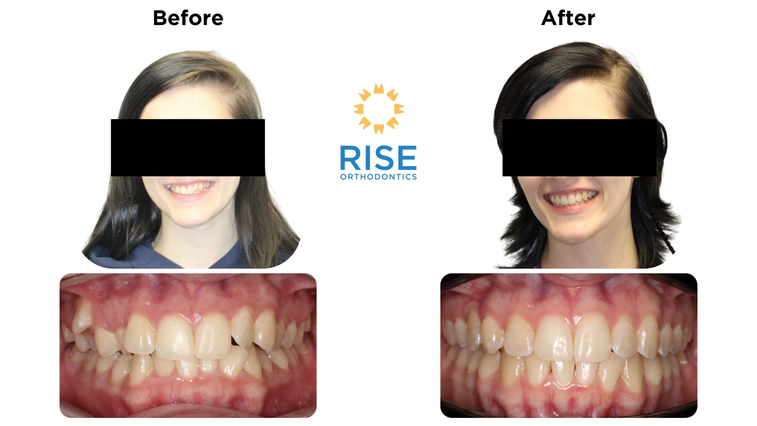 Before and after images of a patient showcasing orthodontic transformation, featuring improved teeth alignment and smile aesthetics, with the Rise Orthodontics logo displayed prominently.