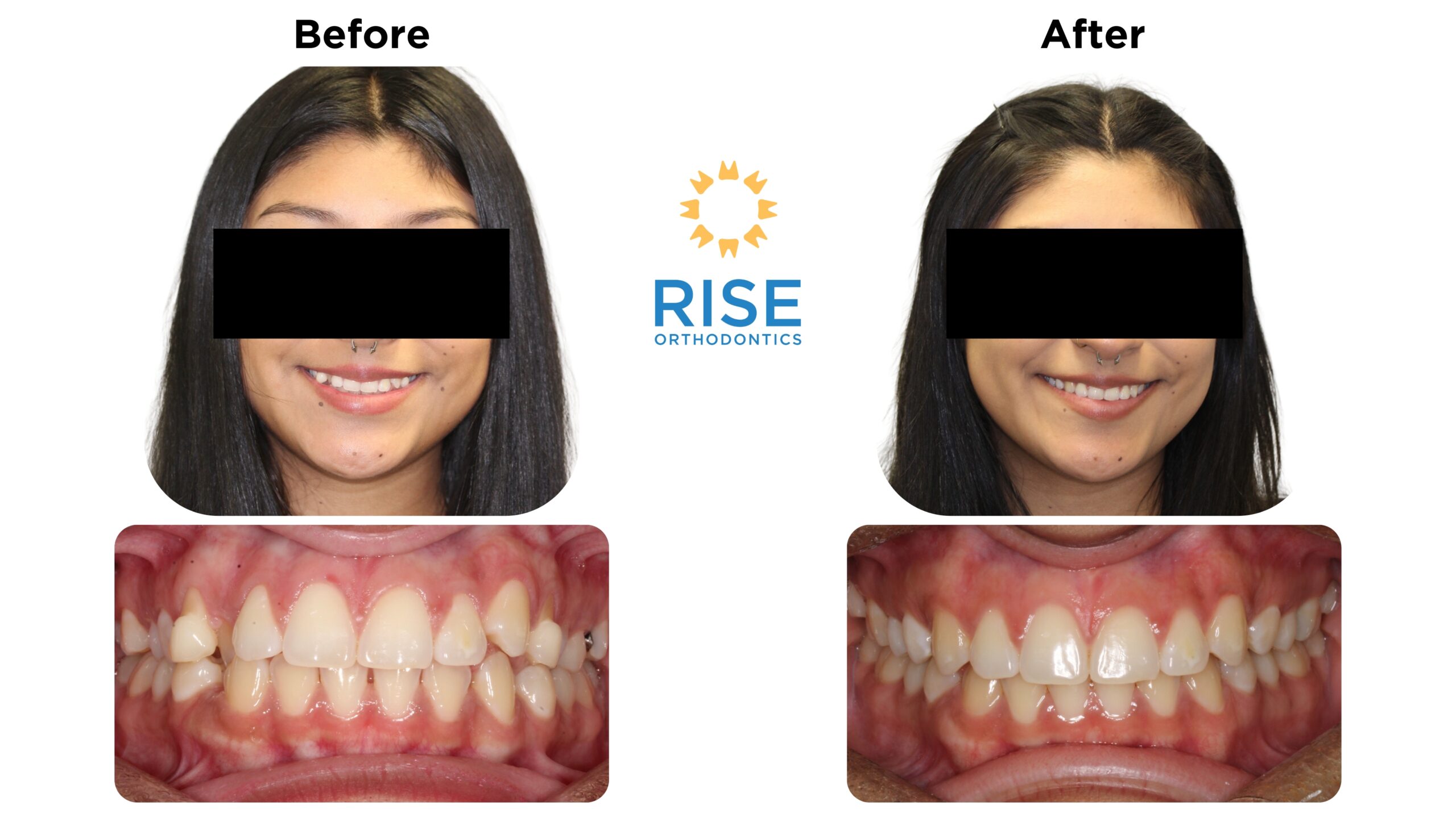 Before and after orthodontic transformation showcasing improved dental aesthetics with braces at Rise Orthodontics, featuring a smiling patient and enhanced teeth alignment.