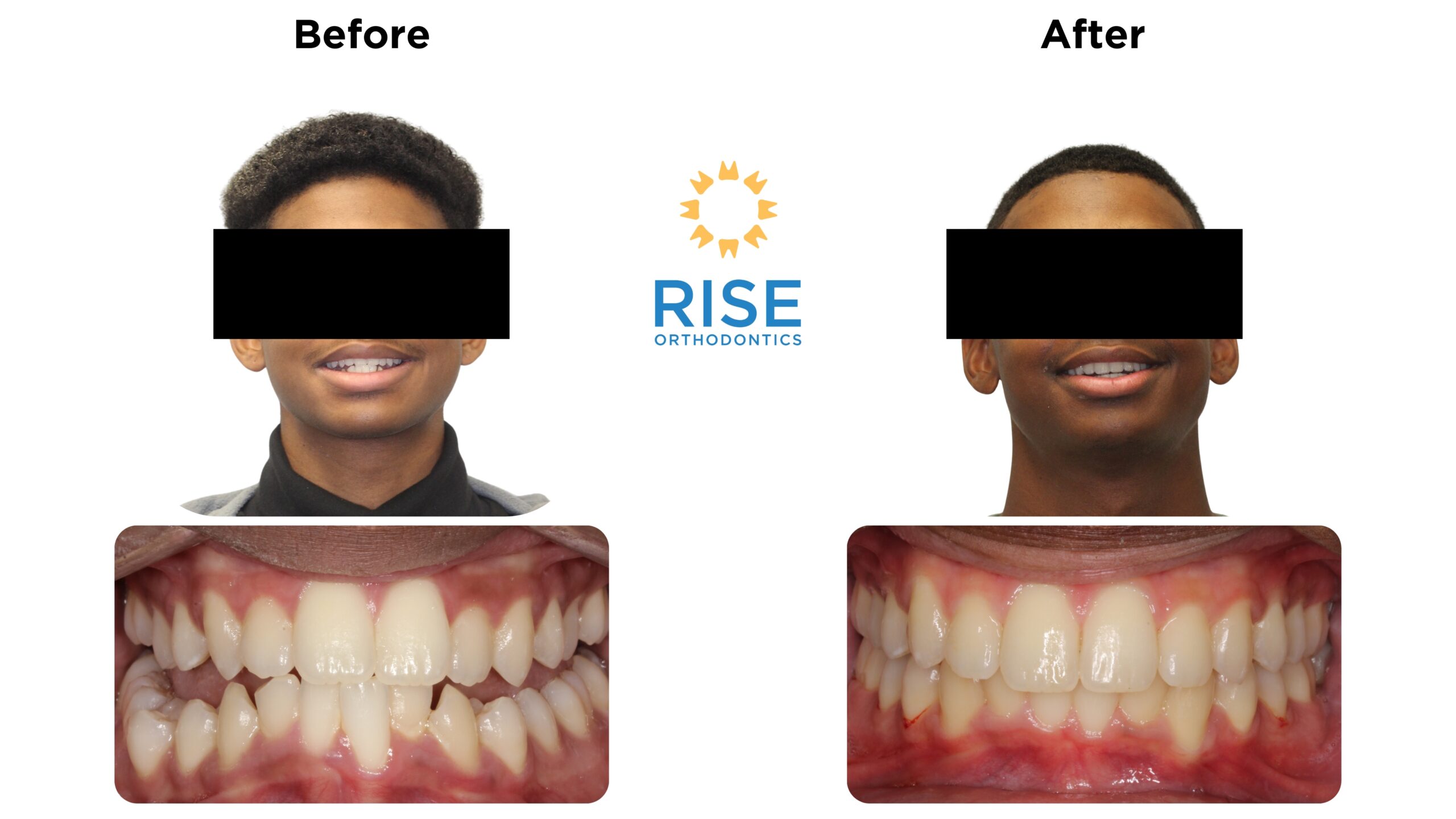 Before and after orthodontic treatment photos showcasing improved smiles, highlighting patient transformations at Rise Orthodontics.