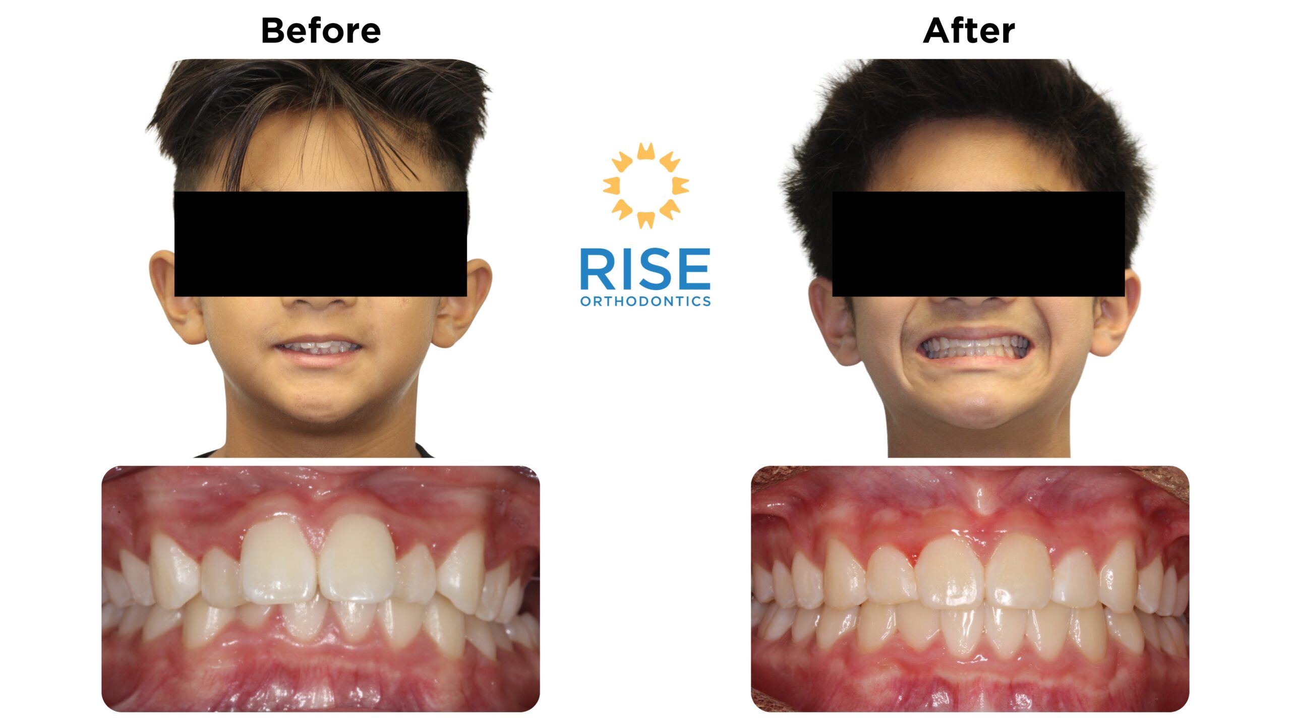Before and after orthodontic treatment images showing a child's smile transformation, featuring improved alignment and aesthetics of teeth, with Rise Orthodontics logo in the center.