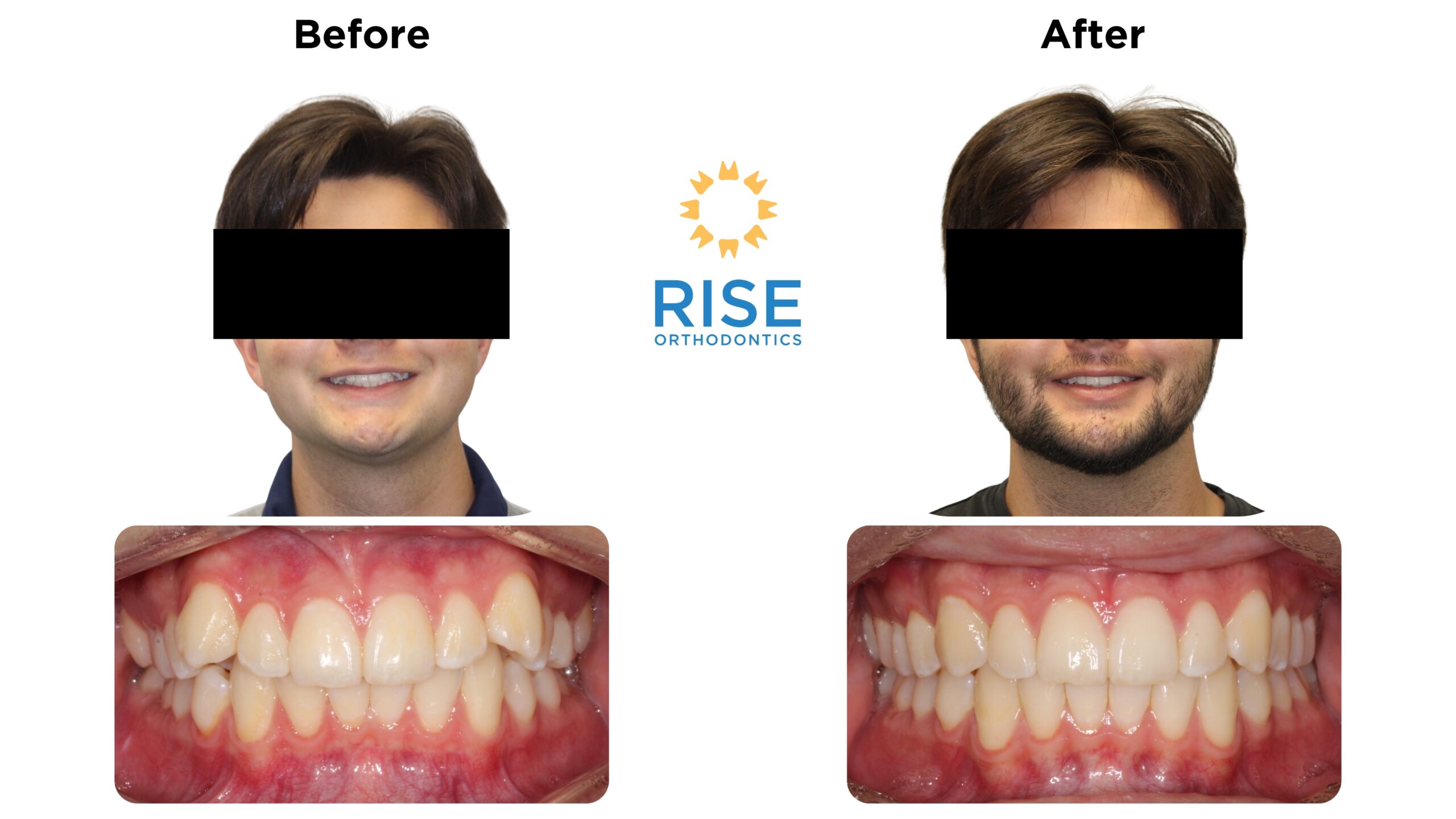 Before and after images of a patient showcasing orthodontic transformation, featuring improved smile aesthetics and alignment, with Rise Orthodontics logo prominently displayed.