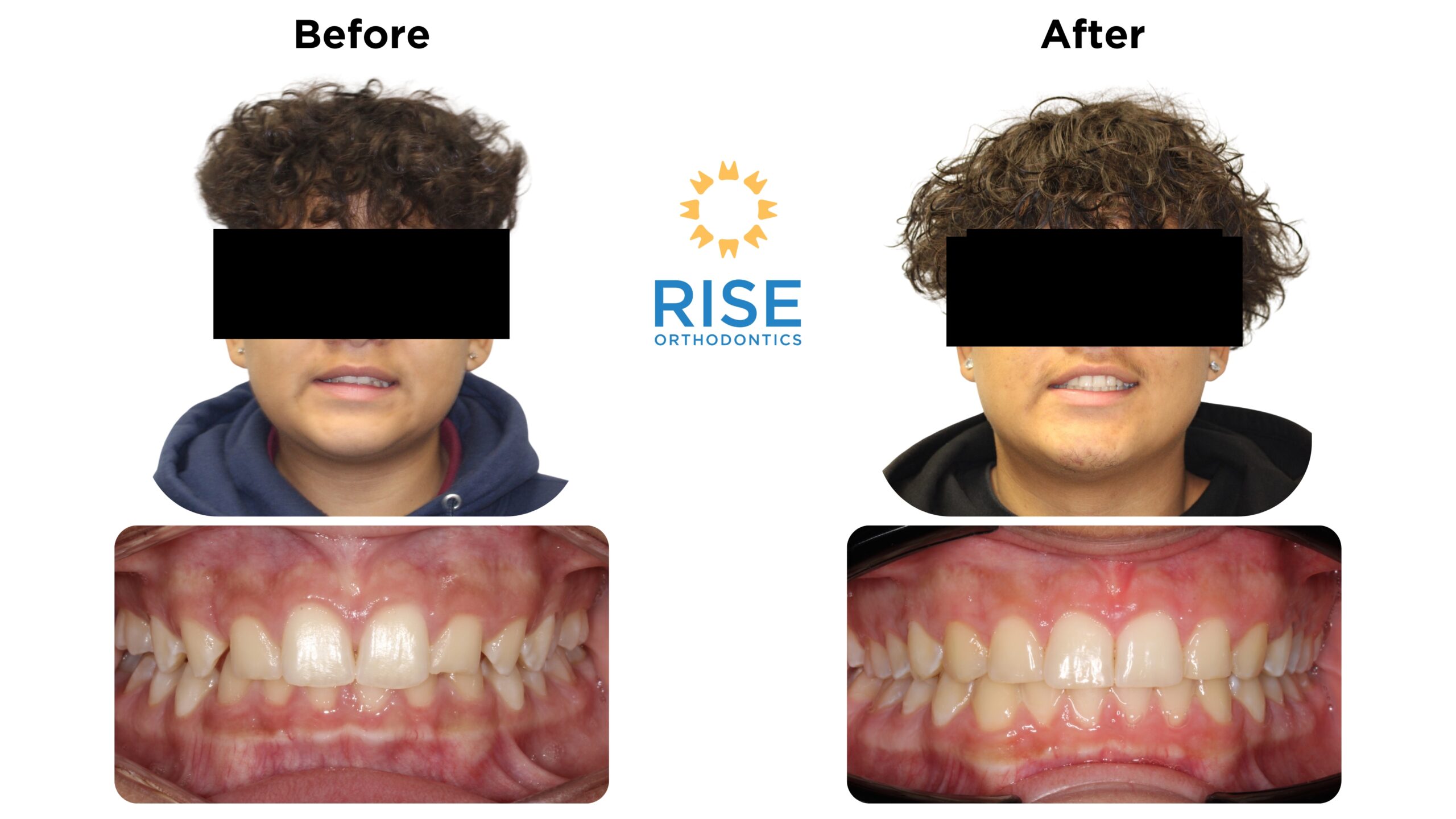 Before and after images of a patient treated at Rise Orthodontics, showing significant dental transformation with improved alignment and aesthetics.
