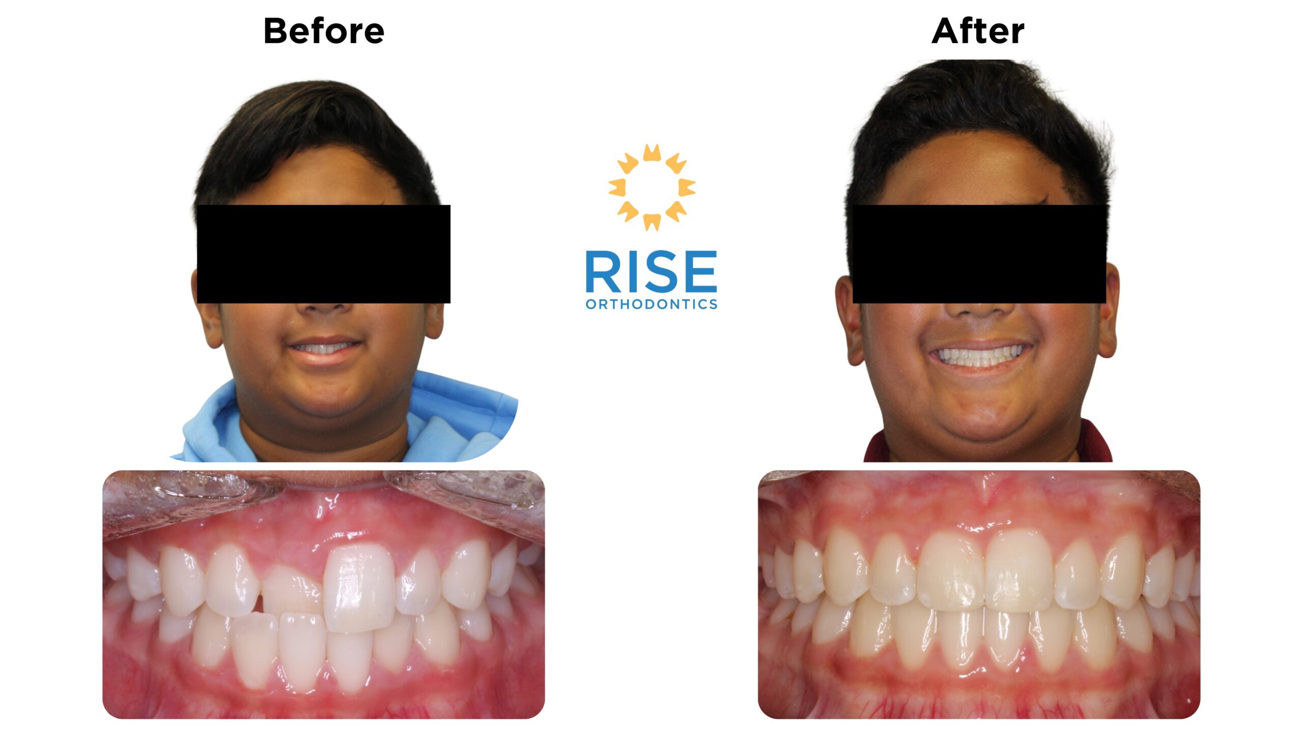 Before and after images of a patient treated at Rise Orthodontics, showcasing significant dental transformation with improved smile aesthetics and alignment.